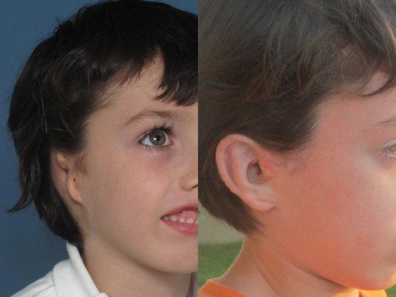 microtia before and after