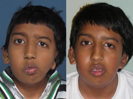 Hemifacial Microsomia before and after