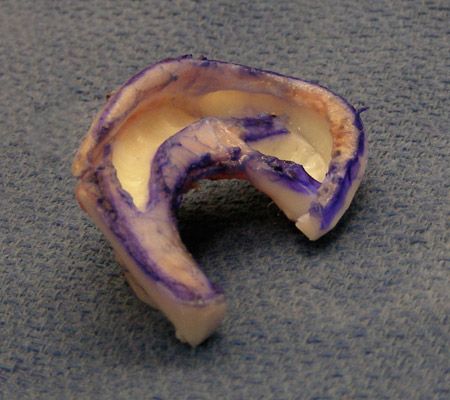 Rib Cartilage Ear Reconstruction