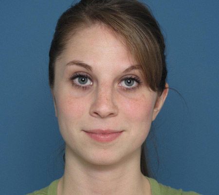 FRONT VIEW OF A RIB CARTILAGE EAR RECONSTRUCTION